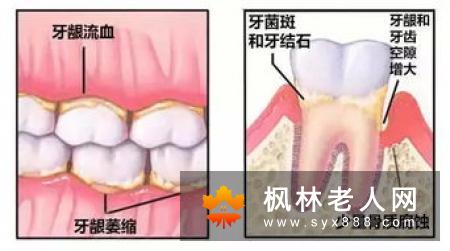 牙周炎都有哪些治疗误区