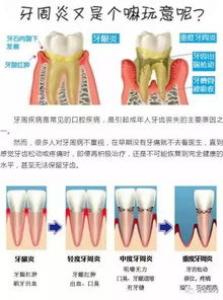 成年人的牙周炎表现是怎样的？