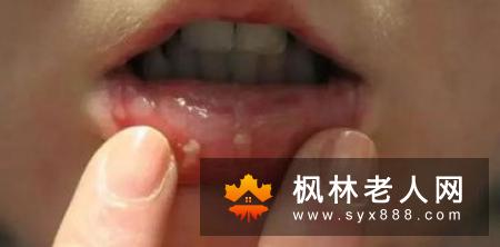 你对口腔溃疡了解多少