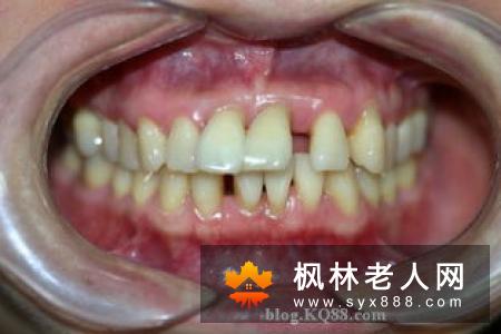 牙周病患者的正畸治疗