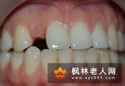 牙龈出血日常该怎么预防？